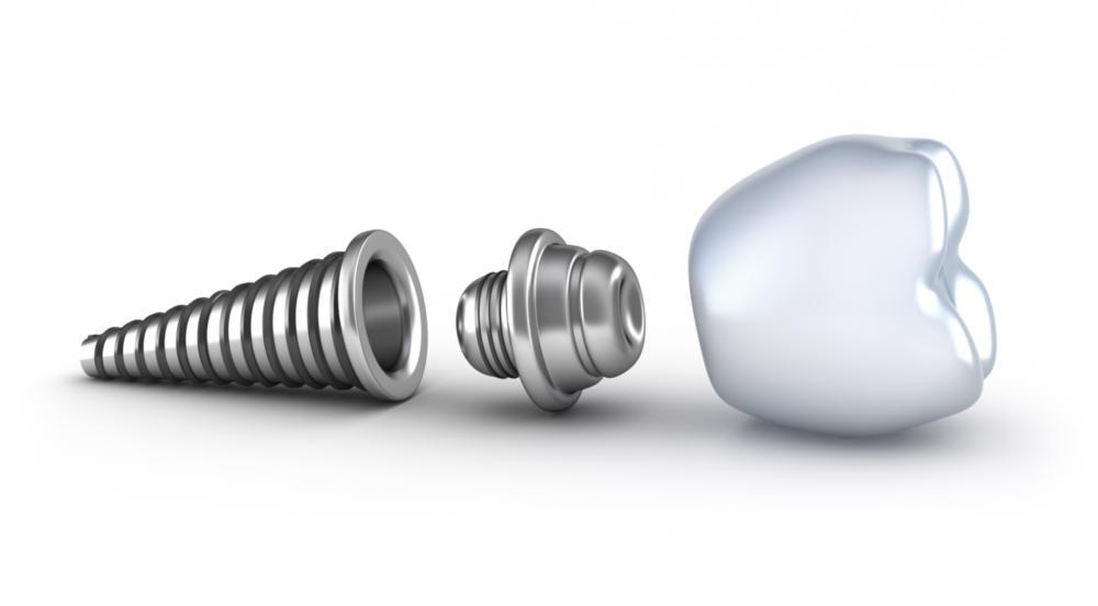 An image of a dental implant in it's different components | Dental Implants Medina OH