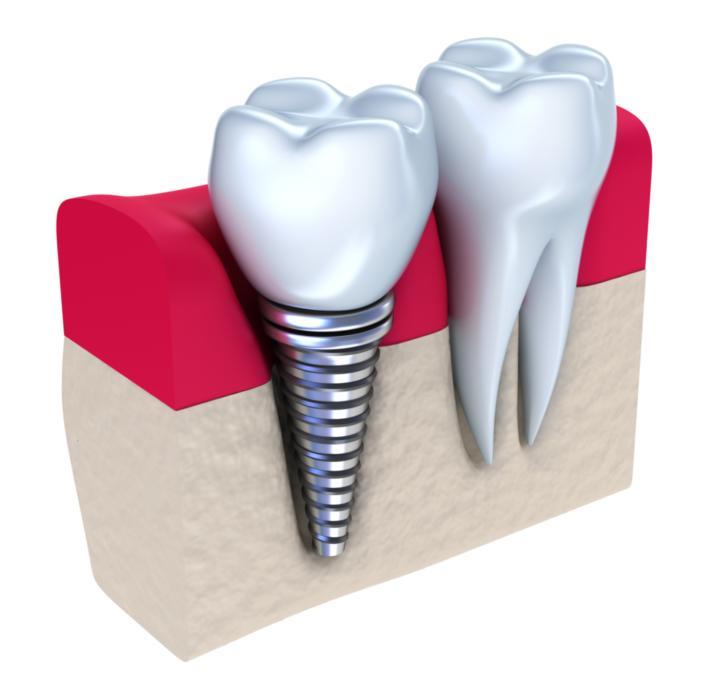 A diagram of a dental implant next to a natural tooth | Dental Implants Medina, OH