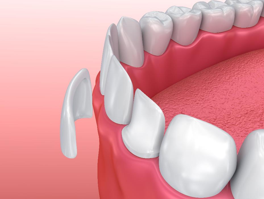 porcelain veneers medina