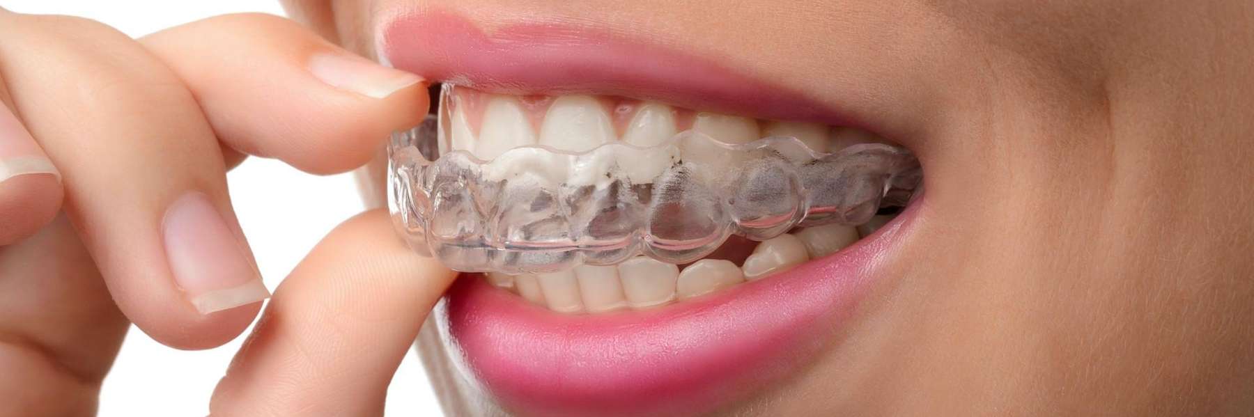 clear braces near me | woman with clear braces