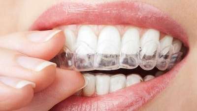 clear braces medina | woman with clear aligners