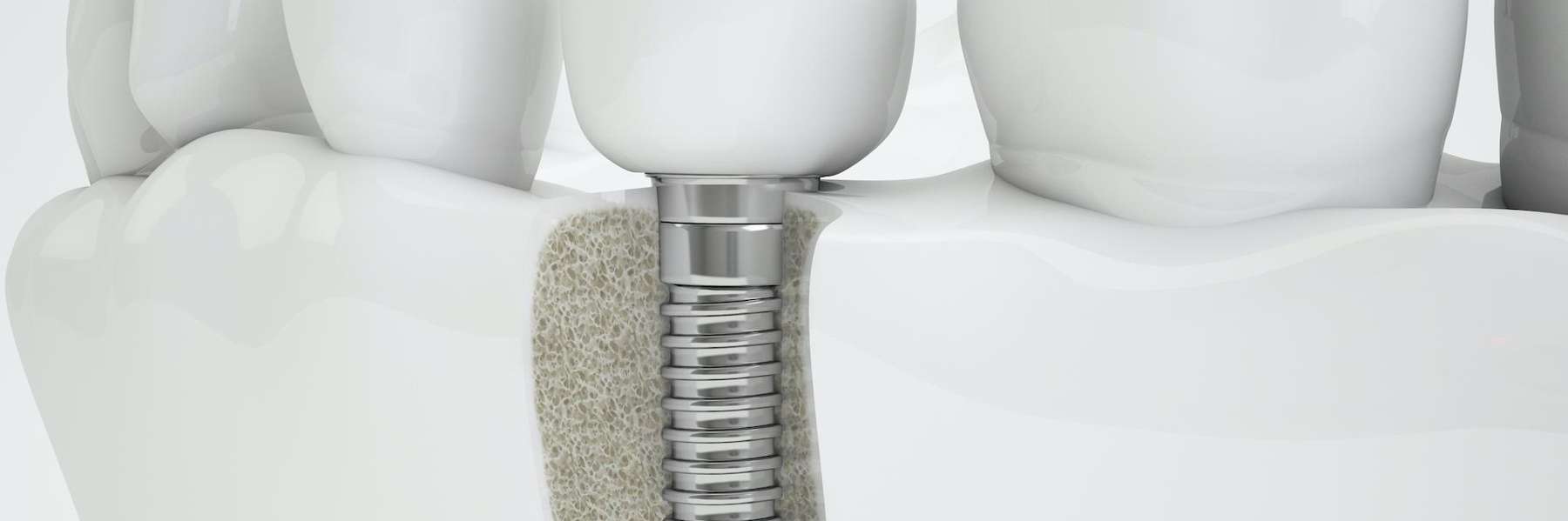 Dental implant with a screw and tooth, highlighting a safe, effective tooth replacement