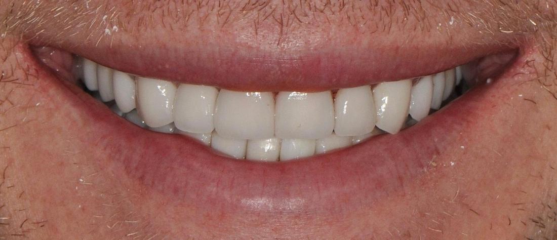 patient after receiving 32 crowns at Sinick Family Dental