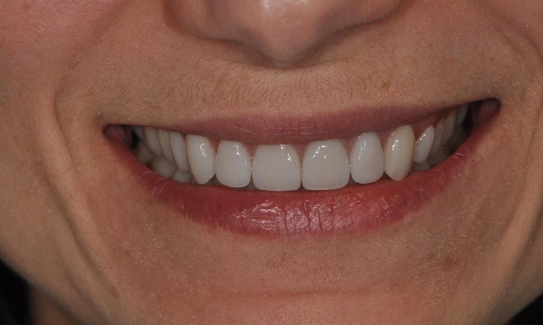 after porcelain veneers at Sinick Family Dental in Medina OH