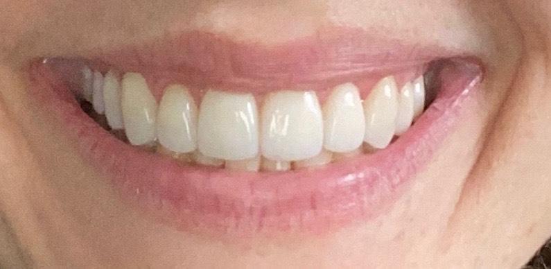 Patient after receiving porcelain veneers at Sinick Family Dental