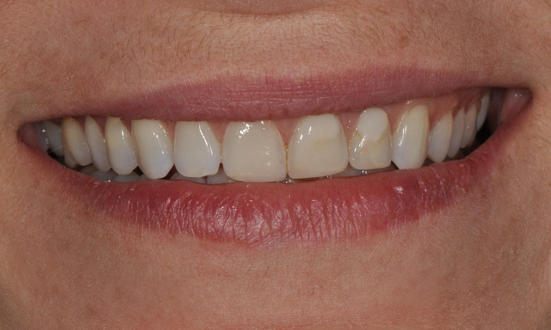 before photo of discolored teeth with composite bonding