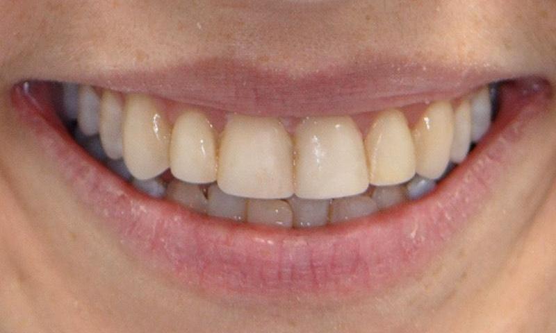 Patient with enamel deficiency before veneers