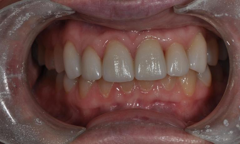 Patient after receiving porcelain veneers in Medina OH