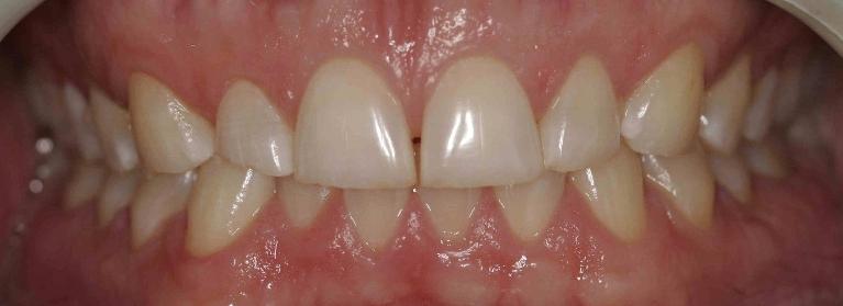 Patient with worn teeth from severe teeth grinding