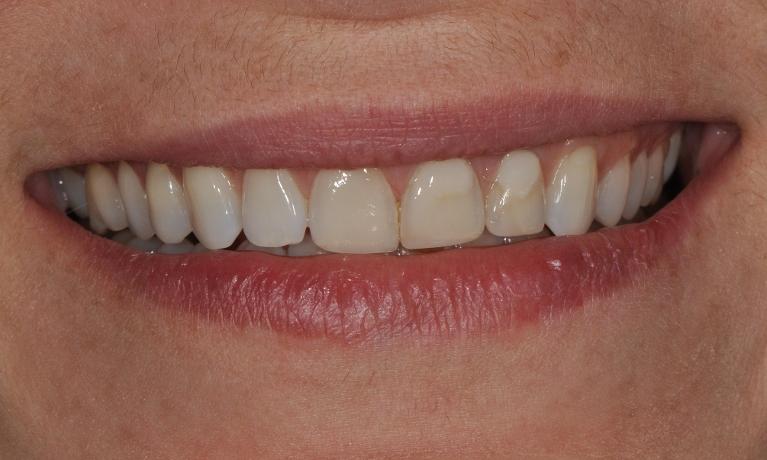 Porcelain-Veneers-Before-and-After-Before-Image