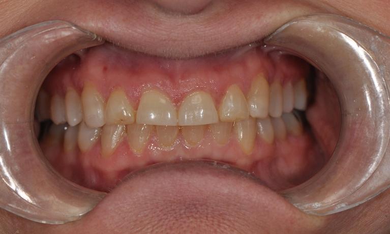 Patient with short teeth before veneers